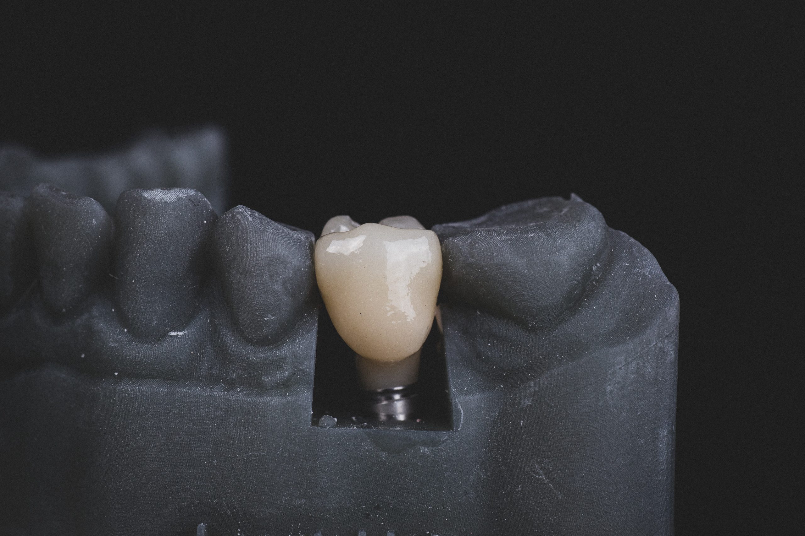 Why Dental Implants Are the Gold Standard for Tooth Replacement