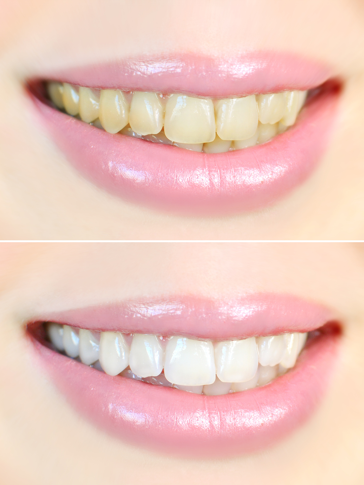 Benefits of Teeth Whitening