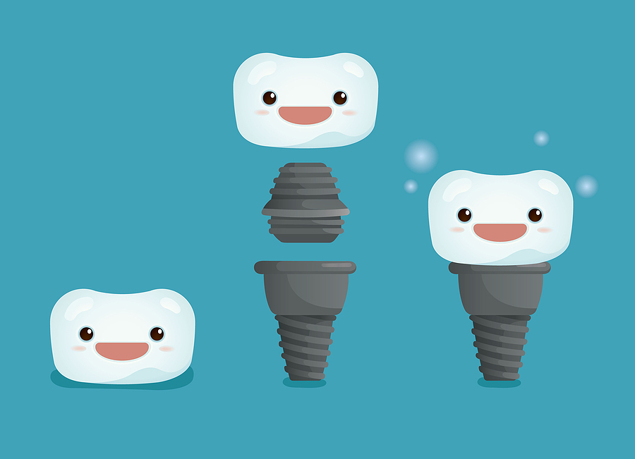 The Ultimate Guide to Dental Implants: A Permanent Solution for Missing Teeth