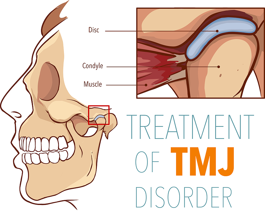 Understanding TMJ Treatment: Relief for Jaw Pain and Discomfort in Kentucky
